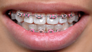 Clear Braces in Hoover — What Are Clear Braces?— Clear Braces Near
