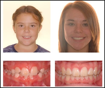 After 7 at Benko Orthodontics in Sarver Kittanning Butler PA